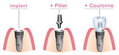 Composants implant dentaire Nîmes 30900